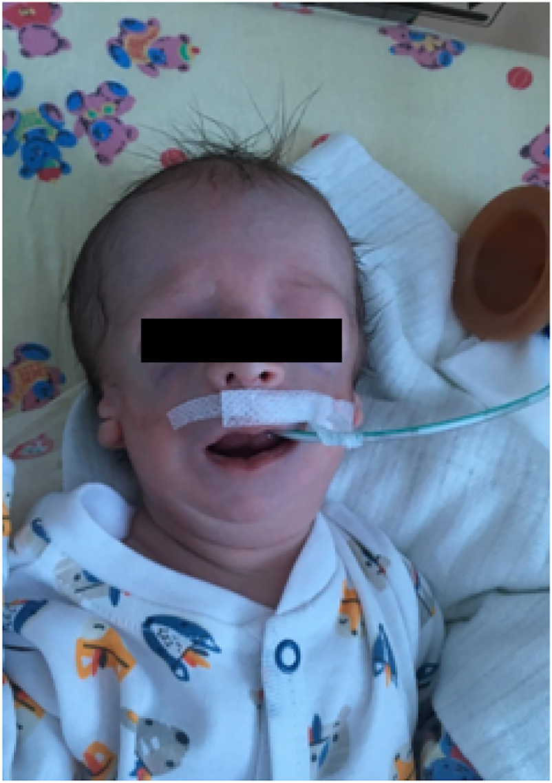 Figure 1:
Our patient with Treacher Collins syndrome after birth.