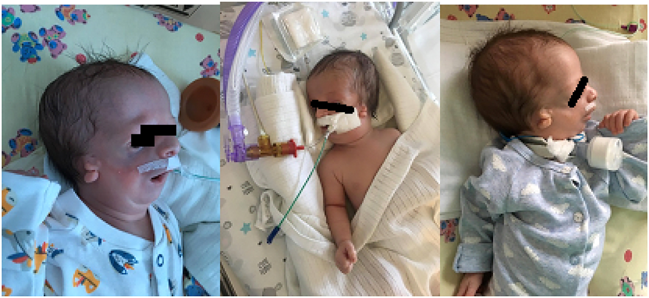 Figure 2:
Typical features of Treacher Collins syndrome in terms of developmental craniofacial disorders in our patient.