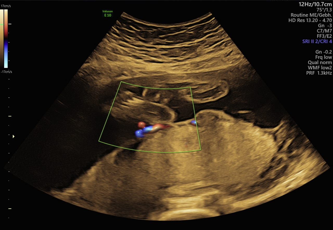 Figure 1: Examination of the cord insertion in 22+1 weeks: normal aspect.
