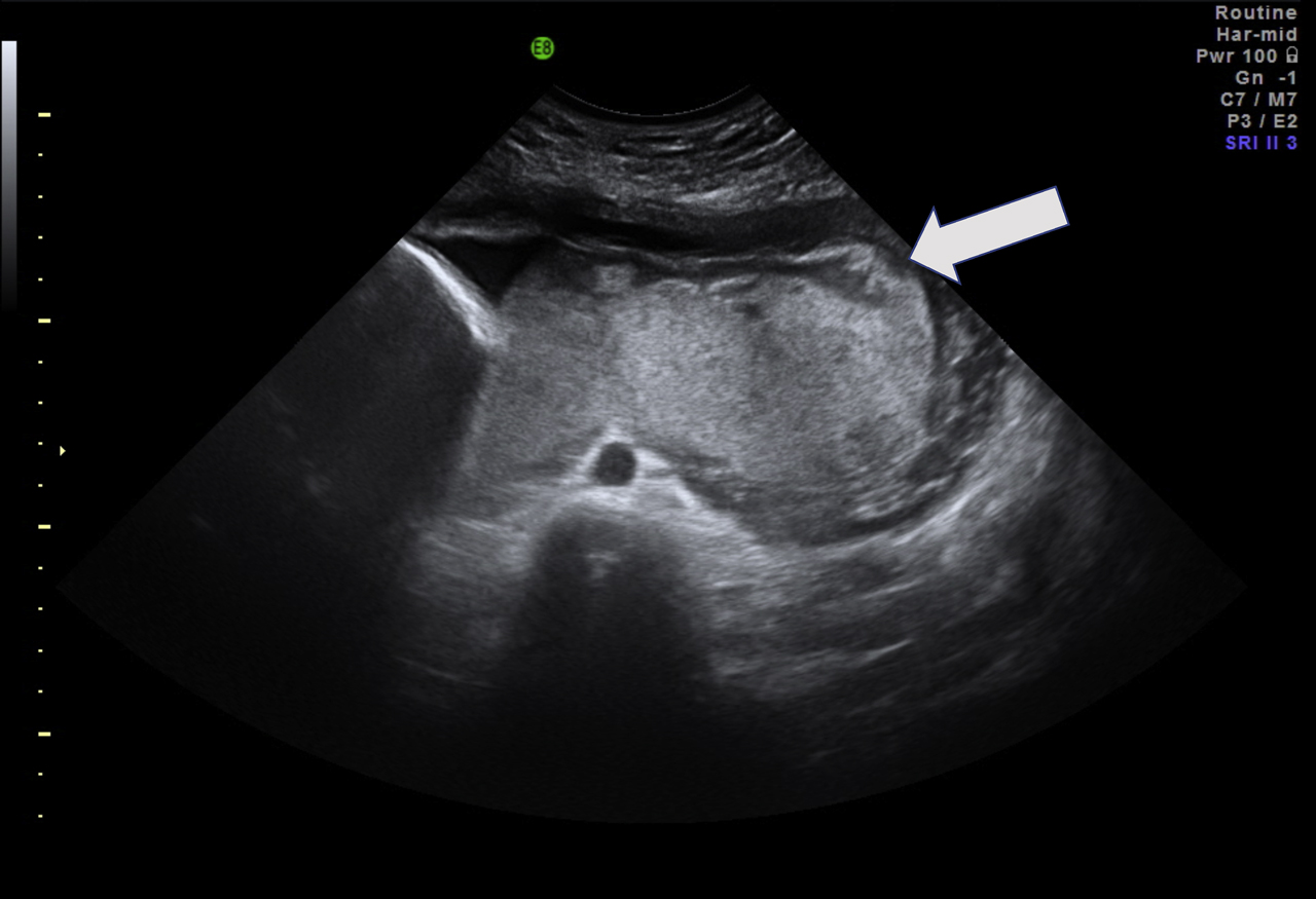 Figure 2: Thickened placenta with atypical echogenicity at 28+2 weeks of pregnancy. Arrow: circumvallate margin.