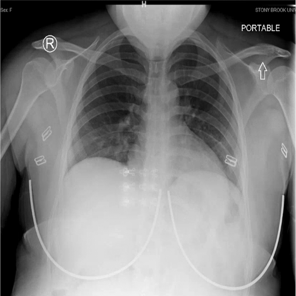Figure 1: Chest X-ray on initial presentation for first admission. Radiologic impression: no acute cardiopulmonary process.