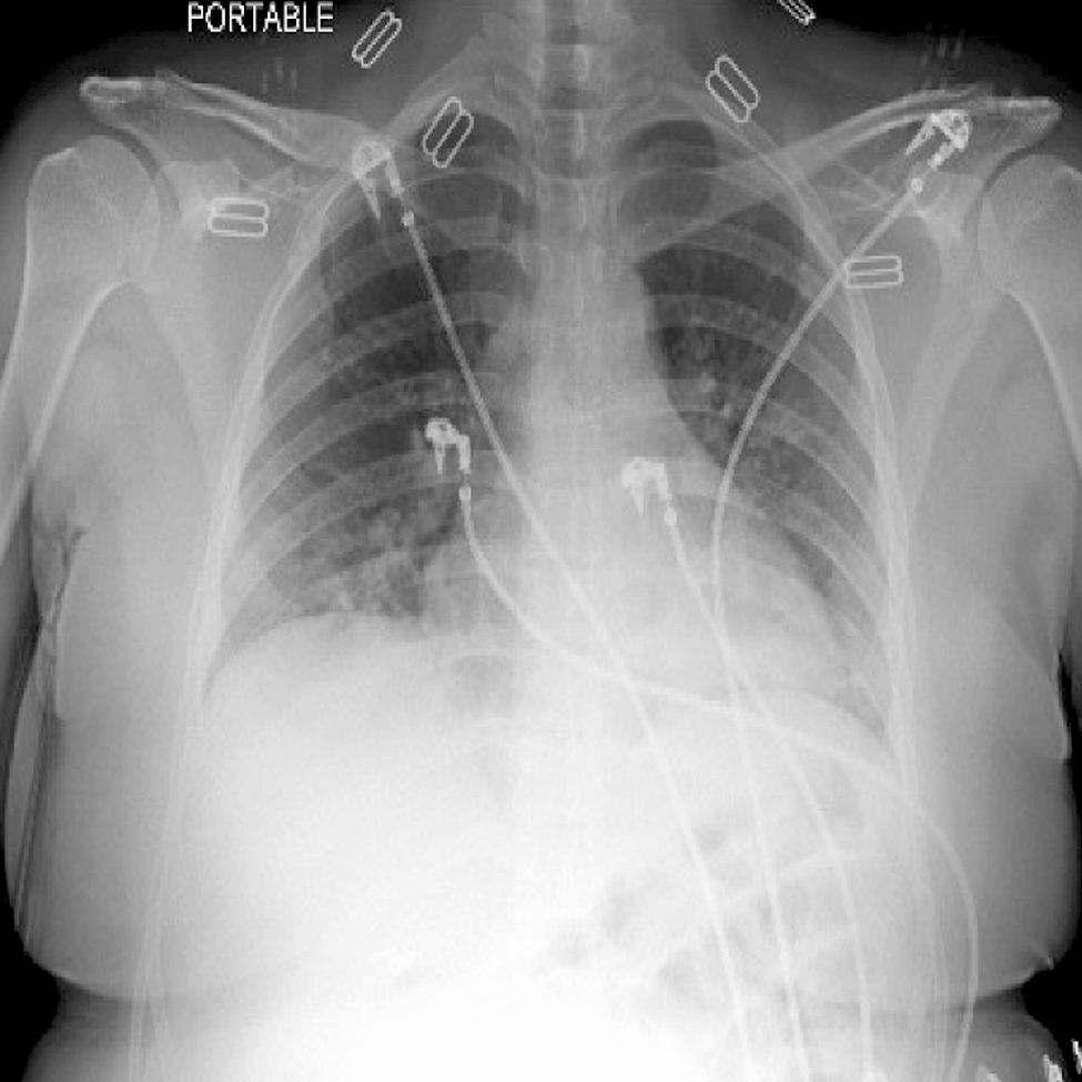 Figure 2: Chest X-ray on representation for second admission. Radiologic impression: patchy airspace opacification in the lower lobes with vascular crowding.