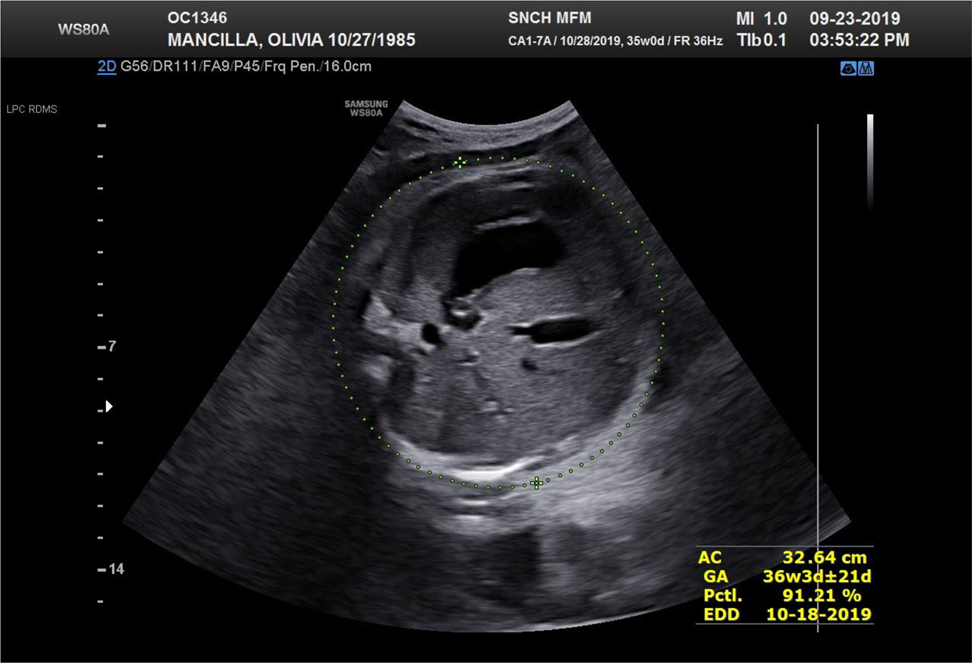 Figure 2: 
Ultrasound image of the fetal abdominal circumference at 35 weeks demonstrating no remarkable fetal ascites.

