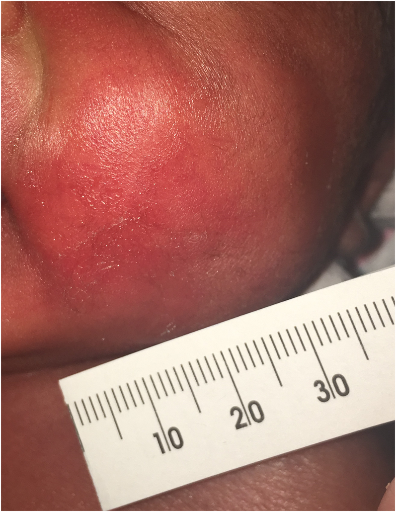 Figure 1:
A tender, flat, violaceous, plaque-like lesion on the left cheek that appeared on day 4.