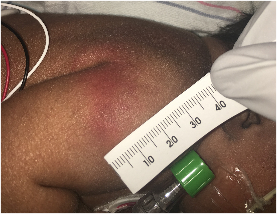 Figure 2:
A firm, well demarcated plaque-like lesion on the right shoulder.