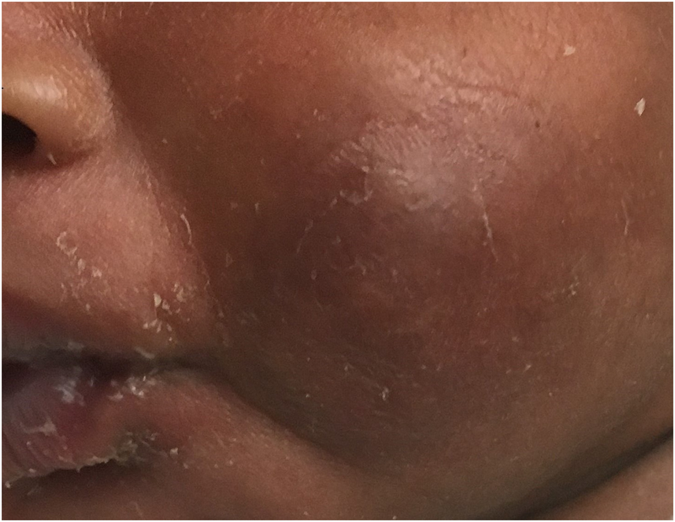 Figure 3:
A scaly eruption on the previously affected areas of the left cheek.