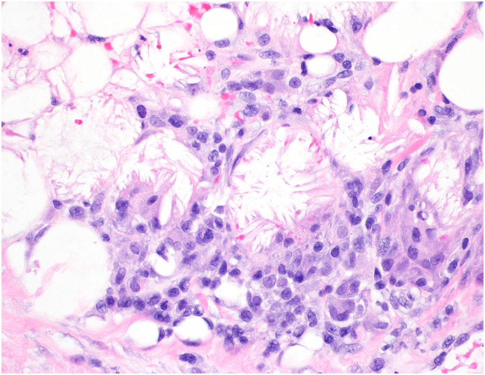 Figure 4:
Histology of the left hip revealed subcutaneous fat necrosis with crystals and focal lymphohistiocytic inflammation.