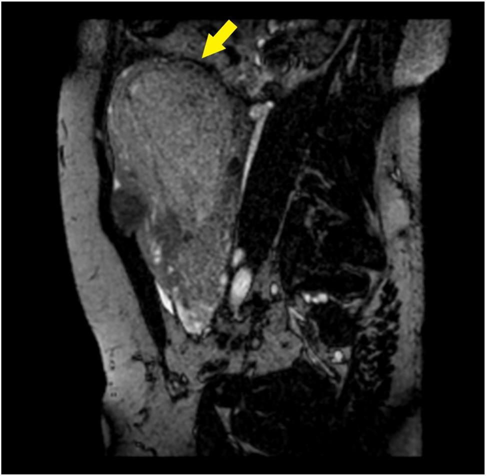 Figure 4: 
Contrast-enhanced MRI.
Para-sagittal BFFE acquisition: the placenta causes marked thinning of the myometrium (arrow).
