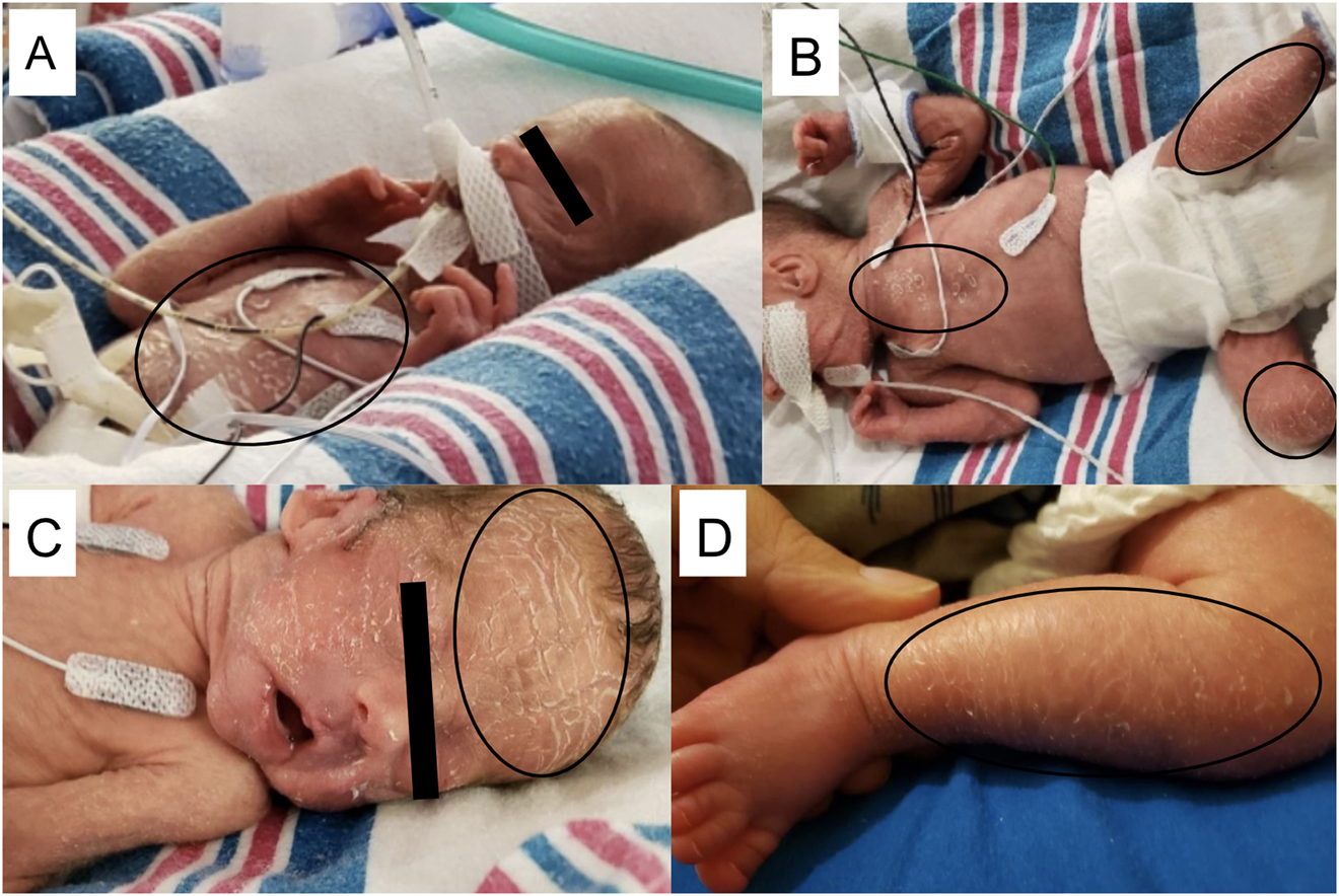 Figure 1: 
X-Linked ichthyosis imitates prematurity: time lapse of physical exam during NICU hospitalization.Dry, peeling skin on day of life 9 (A), day of life 17 (B), day of life 29 (C). Hyperpigmentation and scales seen on lower extremities on day of life 81 (D).
