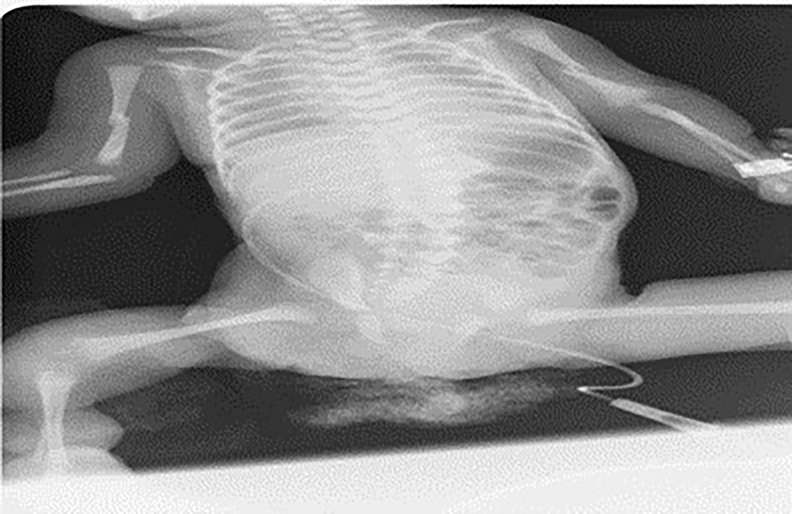 Figure 2: 
Diaphyseal fractures of humerus bilaterally show up 6th day of treatment.
