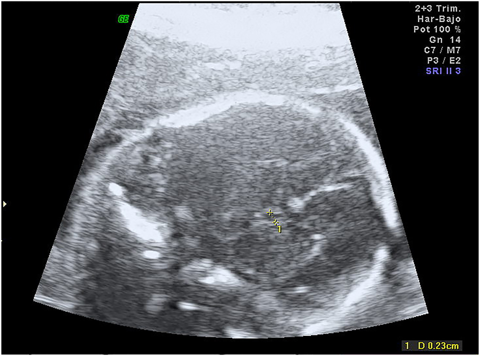 Figure 1:
Transverse view of the fetal head at 22 weeks gestation showing small cavum septum pellucidum.