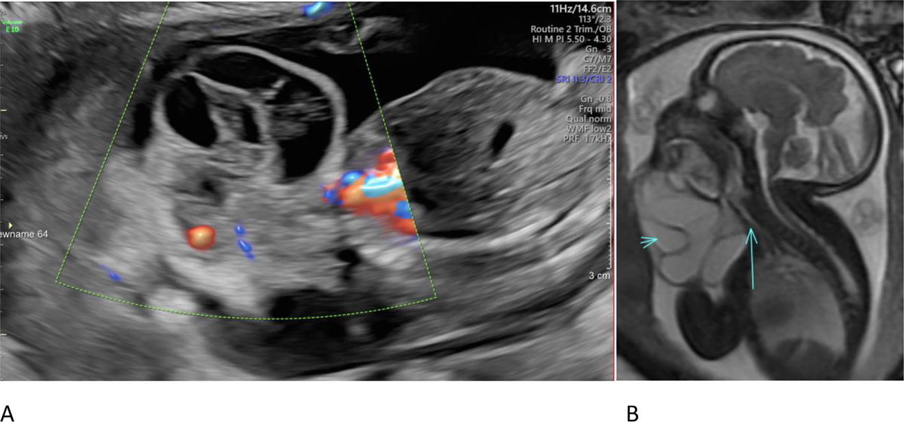 Figure 1: 
Figure Images at different weeks of pregnancy.
(A) Fetal ultrasound sagittal image at 21 weeks demonstrated a septated cystic neck mass with absent internal blood flow. (B) Fetal MRI T2 FIESTA sagittal image at 32 weeks demonstrates a cystic neck mass (short arrow) with oral cavity involvement and abutment of the trachea (long arrow).
