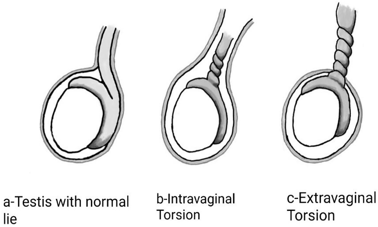 Figure 2:
The different types of testicular torsion.