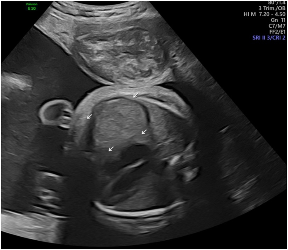 Figure 1: 
Prenatally the right-side diaphragmatic eventration was suspected and differentiated from diaphragmatic hernia at 30 weeks.
