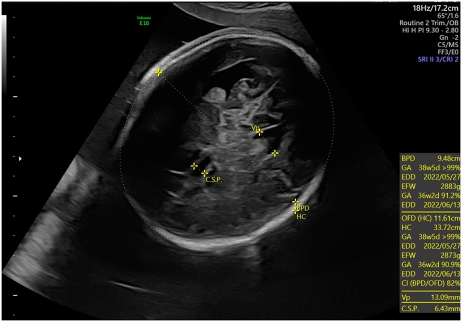Figure 3: 
Macrocephaly (head circumference +3 SD) and ventriculomegaly (lateral ventricles 13 mm) for the fetus with cDM at 32 weeks.
