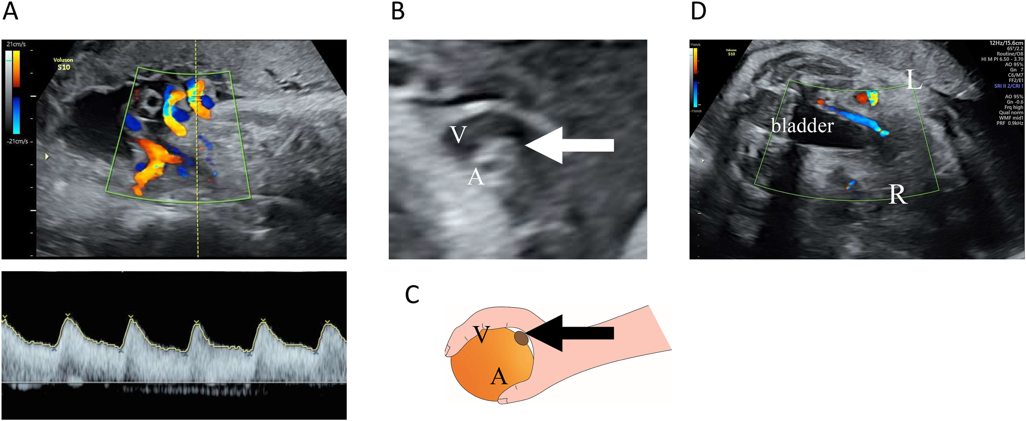 Figure 2: 
Ultrasound examination. (A) Transabdominal ultrasound images of the umbilical arteries and veins. Color flow mapping images of the umbilical cord blood flow. An opposing blood flow was seen in only one artery, indicating extensive disruption of blood flow in one umbilical artery. No abnormal findings were observed in the pulsed Doppler waveform for the umbilical artery with blood flow. (B and C) The ‘orange grab sign’ in B mode. A highly curved umbilical vein (V) surrounding an umbilical artery with blood flow (A) and an umbilical artery with an interrupted blood flow (arrow) was seen between them. (D) Horizontal section at the level of the fetal bladder. The right umbilical artery running on the right side of the bladder was observed to have an interrupted blood flow.
