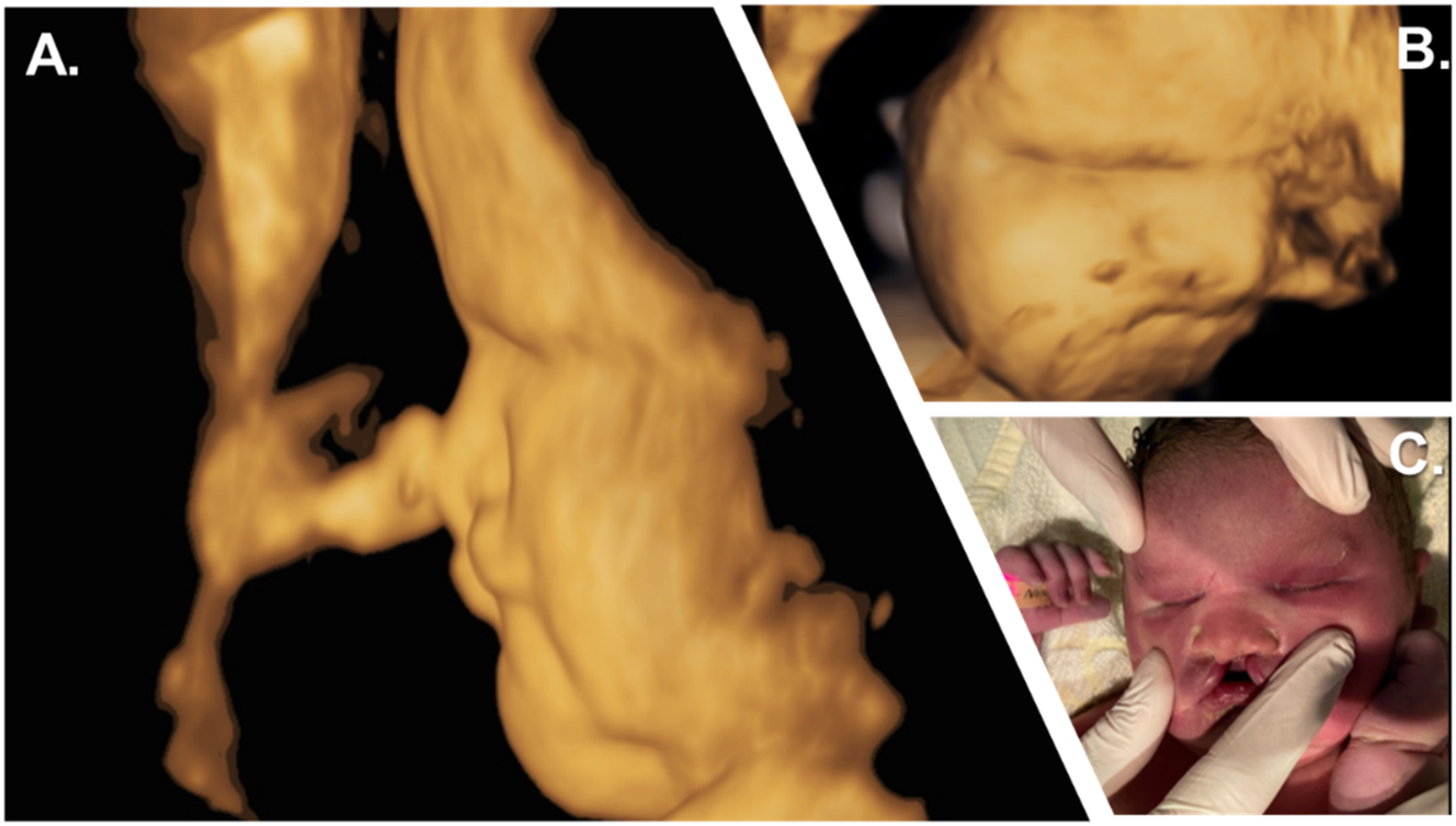 Figure 2: 
Prenatal and postnatal facial characteristics. (A, B) 3D surface sagittal view of the child’s face at 39 weeks of gestation showing craniofacial hypoplasia with a flat nose. (C) Initial examination showed the neonate’s fused eyelids, bilateral cleft lip and jaw with a suggestive philtrum, complete absence of premaxilla, and total vomer aplasia.

