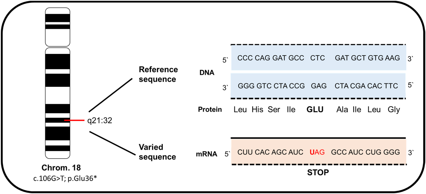 Figure 4: 
Illustration of the homozygous variant c.106G>T; p.Glu36* in the RAX gene located on chromosome 18 from our patient. This mutation leads to the formation of a stop codon, causing a nonsense-mediated mRNA decay and resulting in a loss of protein function.
