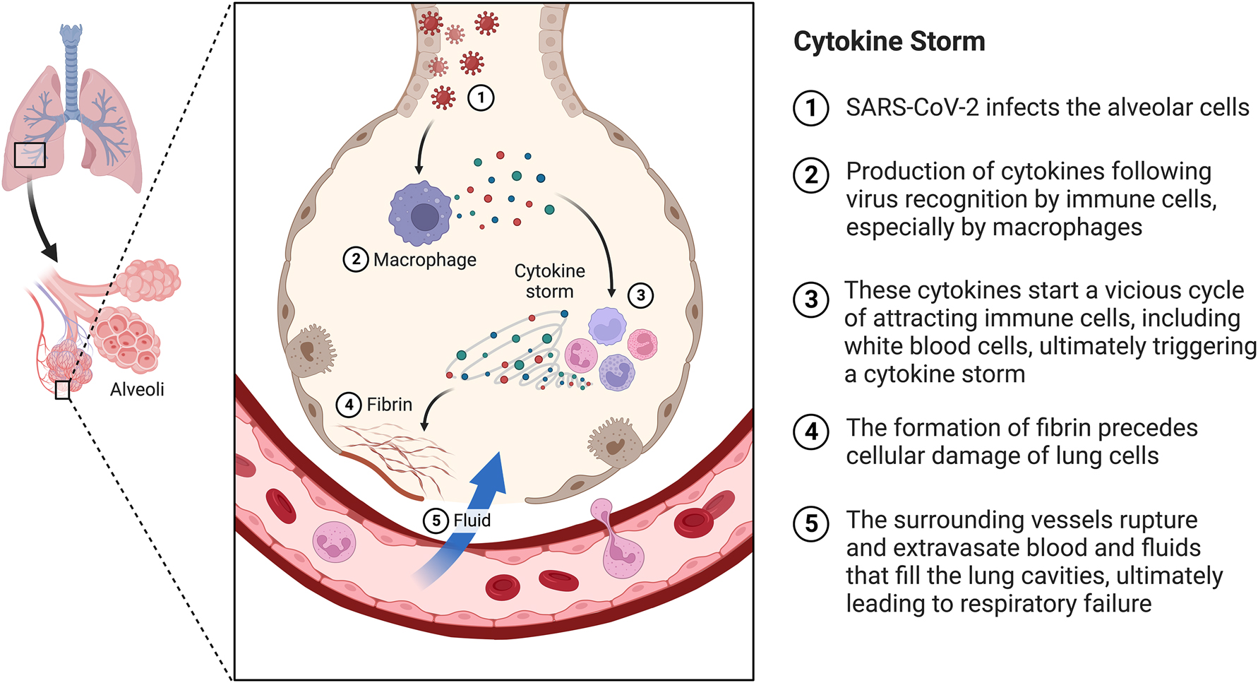 Figure 1:
The mechanism of progression of Acute Respiratory Distress Syndrome (ARDS) following SARS-CoV-2 infection.