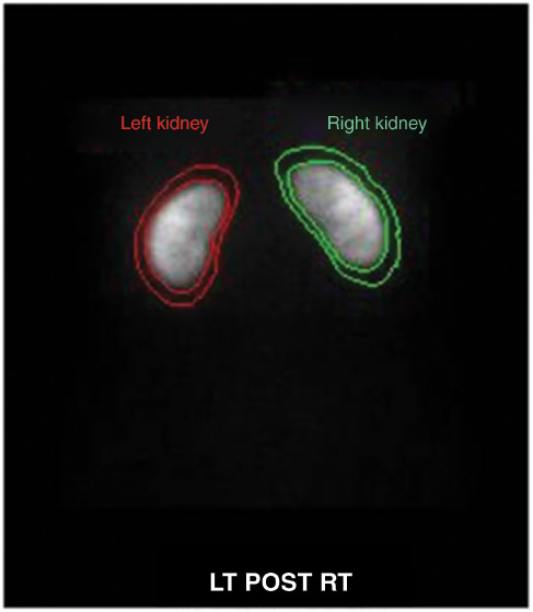 Figure 1 The image analysis and kidney and background region of interests.