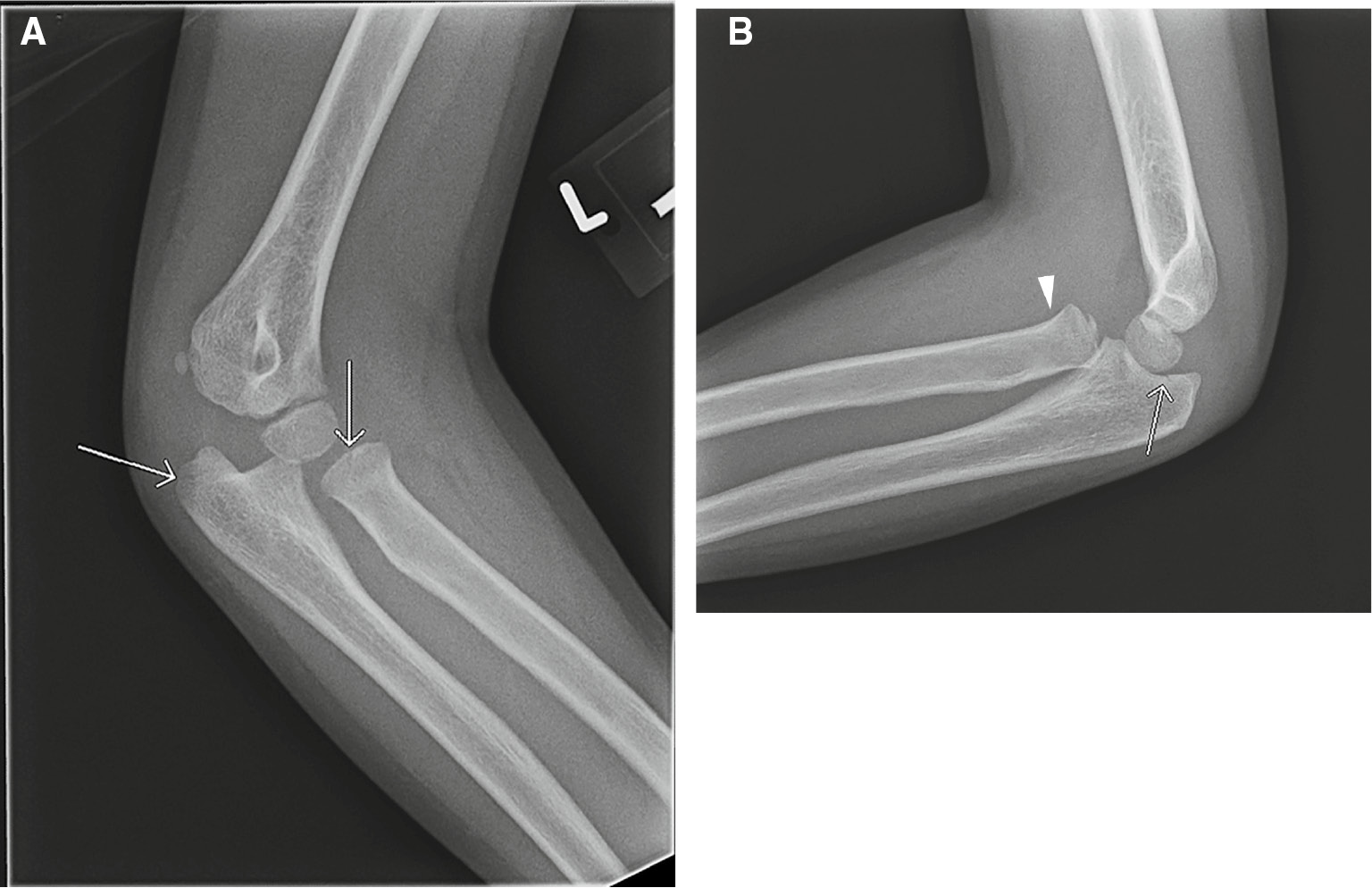 Figure 1: Satisfaction of search error.A 7-year-old male with elbow pain and limited range of motion after fall. Two of the four X-rays obtained are shown. Subtle, nondisplaced fractures of the radial head and olecranon were identified on oblique (A) and lateral (B) radiographs (arrows). An anterior dislocation of the radial head (arrowhead) was missed.