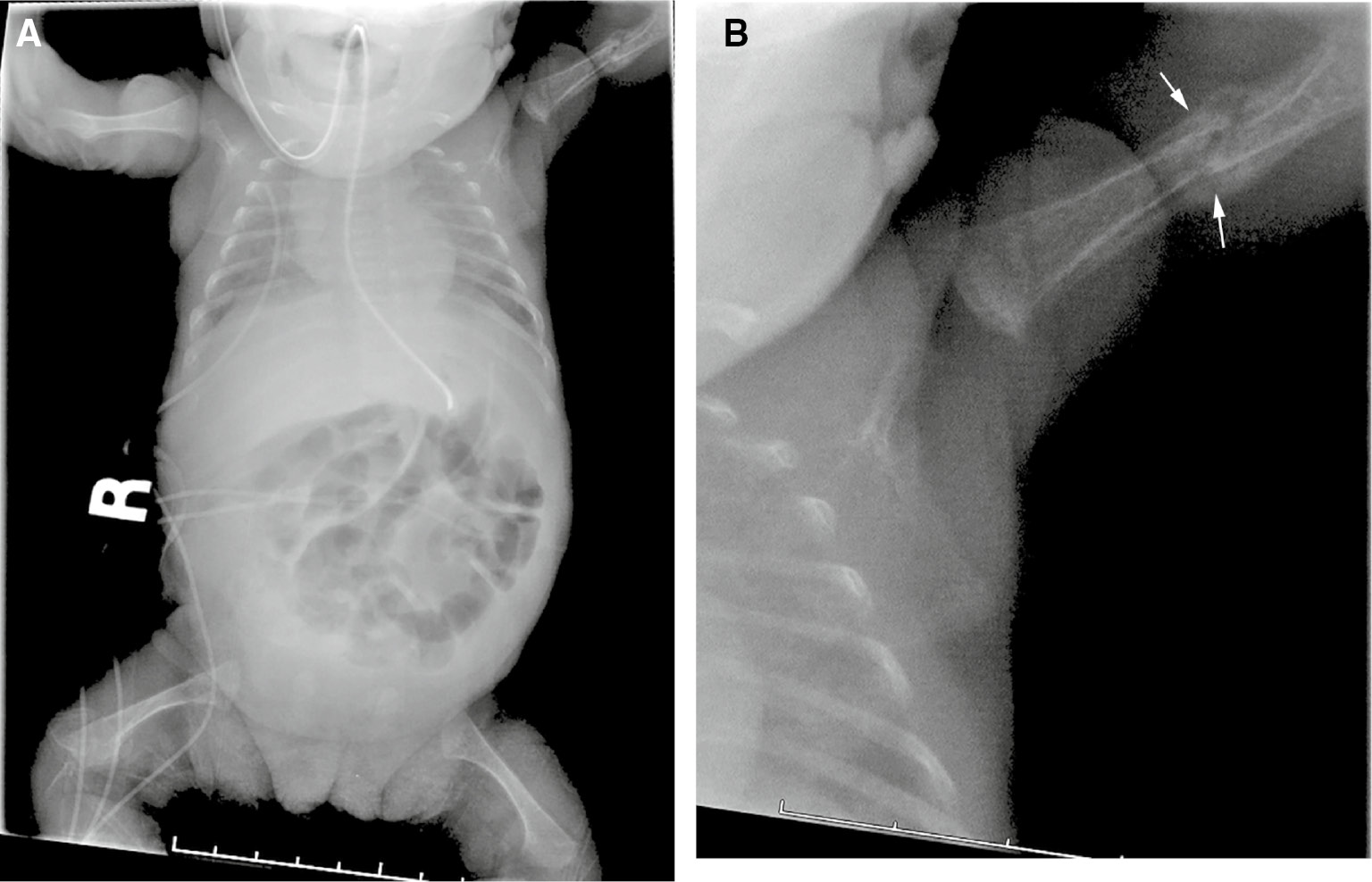Figure 2: Visual isolation error.A 2-week-old, former 24-week gestation infant with chronic lung disease. The X-ray was obtained to confirm location of a feeding tube within the stomach. Frontal view of the chest and abdomen (A) shows the feeding tube in adequate position. A healing left humerus fracture (arrows, B) was missed.