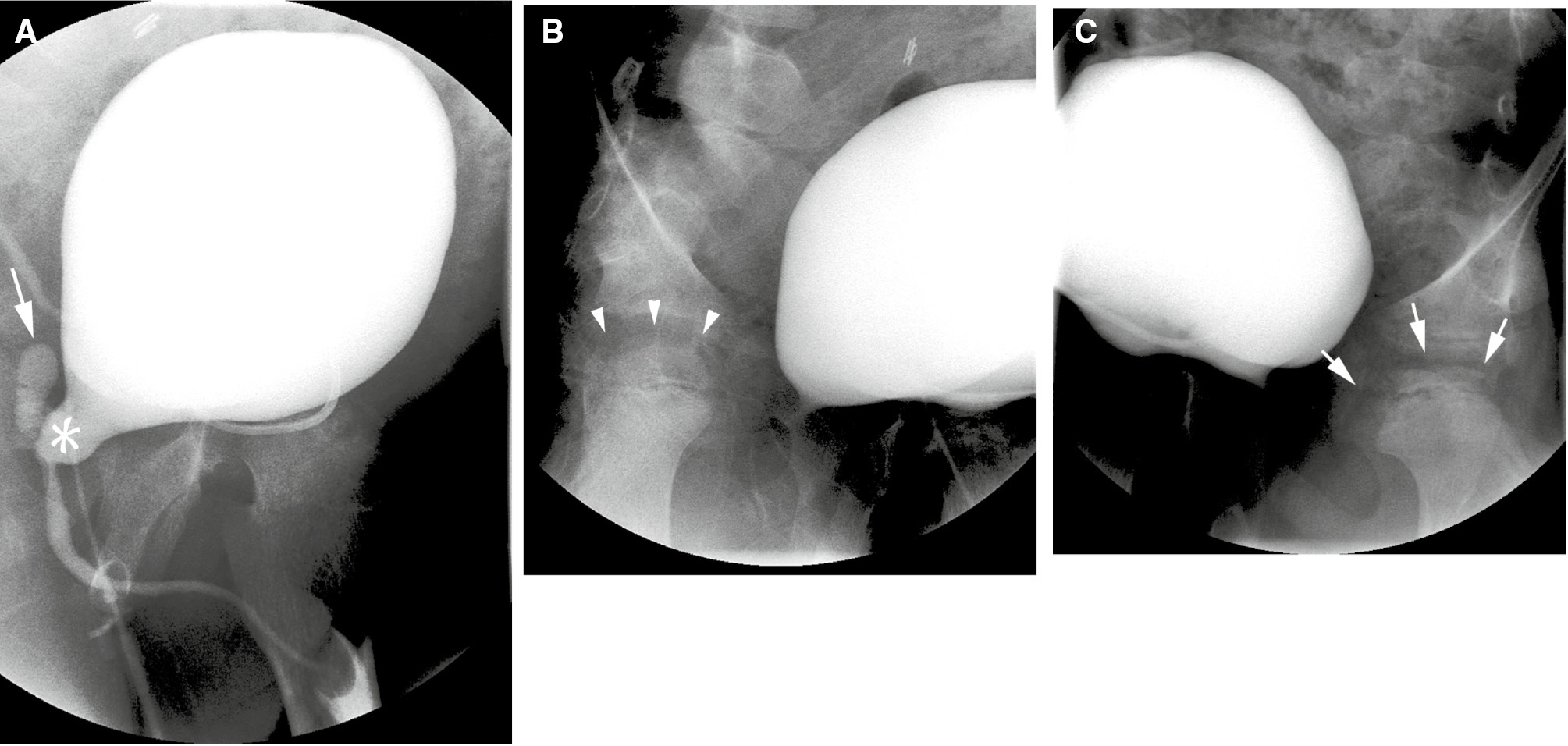 Figure 3: Inattentional blindness error.Voiding cystourethrogram in a 9-year-old male with treated posterior urethral valves. Three images from the study are shown. Oblique view of the bladder during voiding (A) shows a dilated posterior urethra (asterisk), and reflux into a dilated utricle (arrow). Right oblique view (B) of the bladder shows a normal femoral head (arrow heads). Left oblique view (C) shows sclerosis and fragmentation changes of the left femoral head due to avascular necrosis (arrows). This unexpected, but radiographically obvious finding was initially missed.