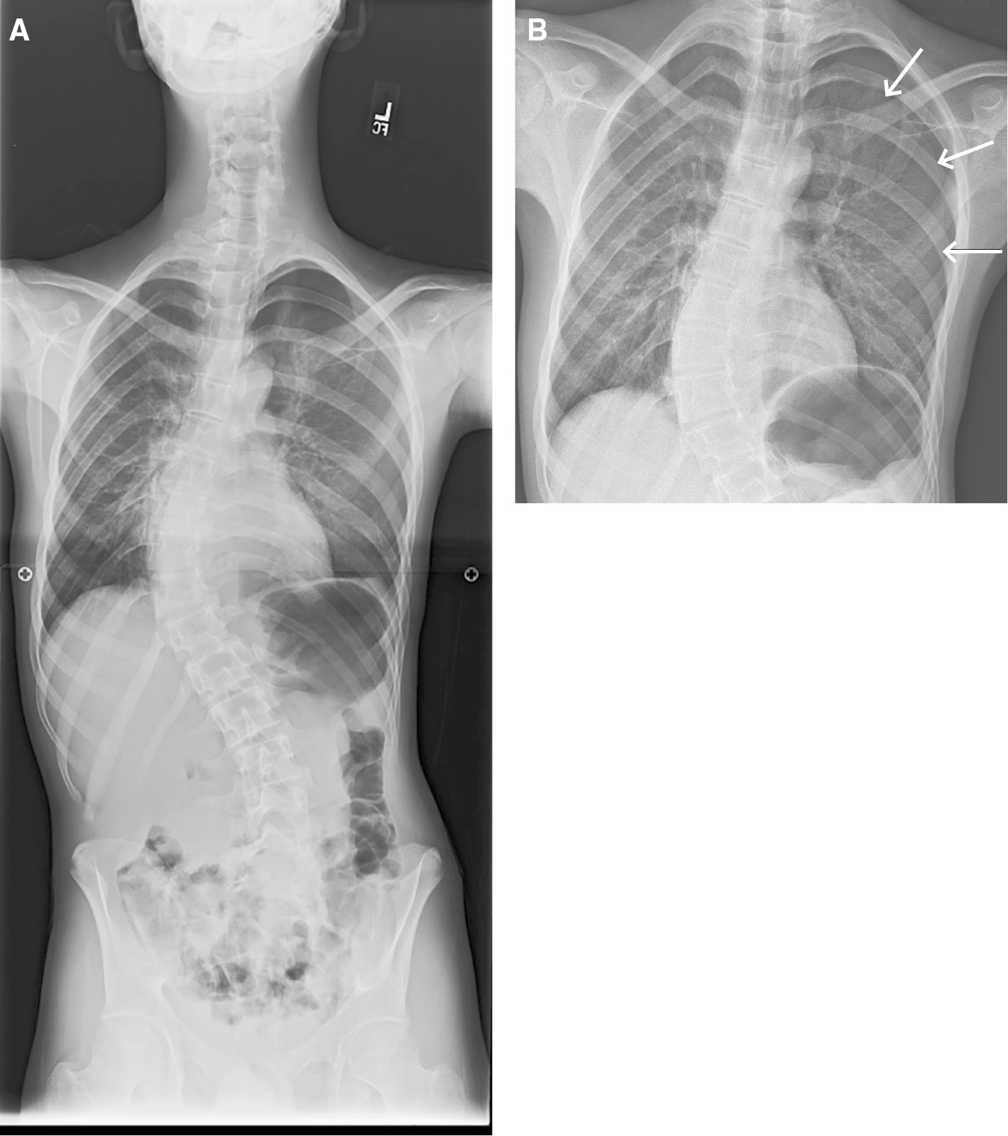 Figure 4: Inattentional blindness error.Frontal radiograph of the entire spine (A) obtained for monitoring of scoliosis in a 15-year-old male with upper back pain. An unexpected, large left pneumothorax (B, arrows) was missed.