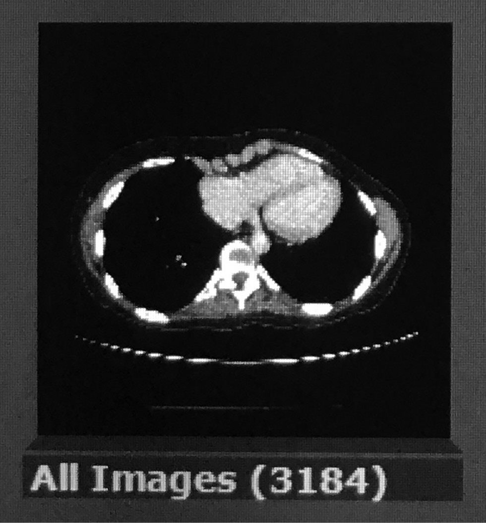 Figure 5: Summary image from a chest CT obtained for evaluation of possible interstitial lung disease shows the number of images contained within the study (3184).