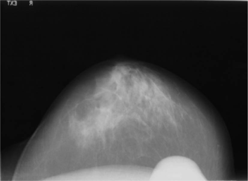 Figure 1: Mammogram.In this mammogram, an artifact (the patient’s nose) obscures part of the image and may serve as a distraction.