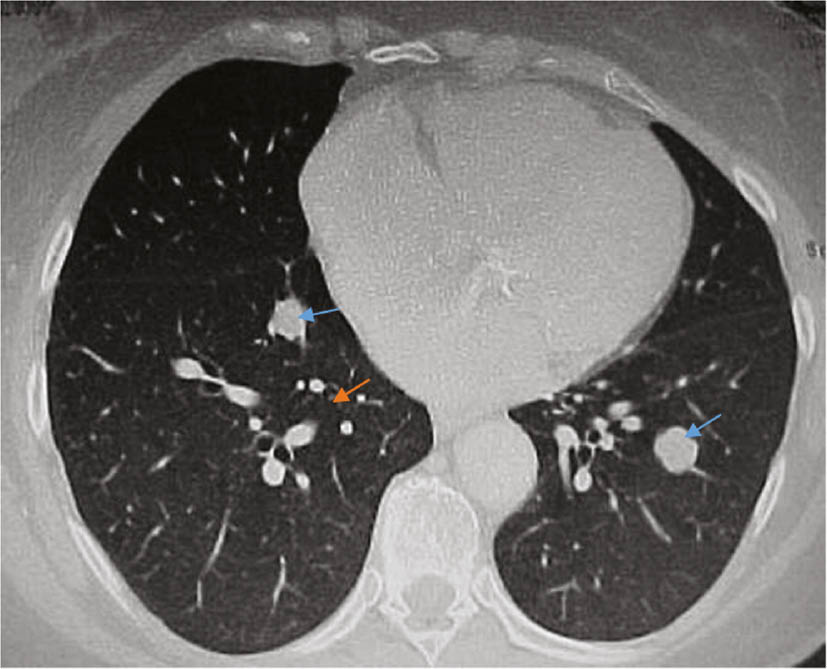 Figure 5: Chest CT.Although several discrete masses are found in the lung parenchyma, the radiologist is able to differentiate those that represent metastasis (blue arrows). Although the visualized features of pulmonary vessels and metastatic tumors are virtually the same, pulmonary vessels (orange arrow) are in typical locations and have continuation on the next slice (image), whereas metastatic tumors are located atypically and review of adjacent slices reveals them to be a more discrete mass. Finally, as the radiologist interacts with all of the obtained lung images, they may conclude that the visualized tumors are indeed metastatic, from some primary tumor which may be situated elsewhere, for example, in the kidney or breast.