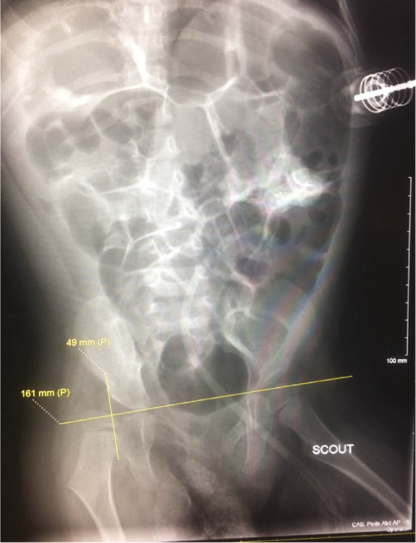 Figure 6: Abdominal X-ray.Example of personalized use of measurement software (color, angles, pining and drawing trajectory, etc.) and the initial causal grasp by the enaction of measuring.