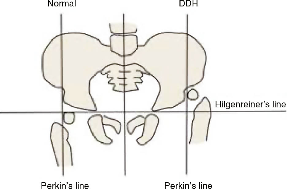 Figure 7: Generalized depiction of Hilgenreiner’s line anatomical sructure.
