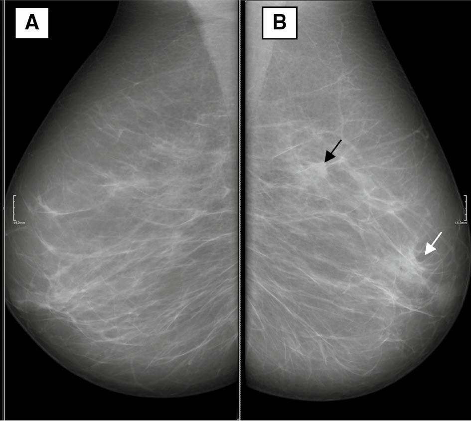 Figure 10: Mammograms.The breast image on panel (A) is not giving much diagnostic information, but on panel (B) it shows a spiculated mass in the upper lateral quadrant of the breast (black arrow) and a similar appearing but benign area of tissue superimposition near the nipple (white arrow). Tissue superimposition may resemble cancer but the radiologist can distinguish the two by, first, locating them in relation to other structures (also see, in this regard, Figure 12), such as a nipple and, second, by identifying the causal relation between structures and tissues: although malignant cancer is separate from other structures, it is experienced as “penetrating”, “spreading”, “piercing”, when all these causal experiences are due to the contextualization of visual detection of spiculated contours.