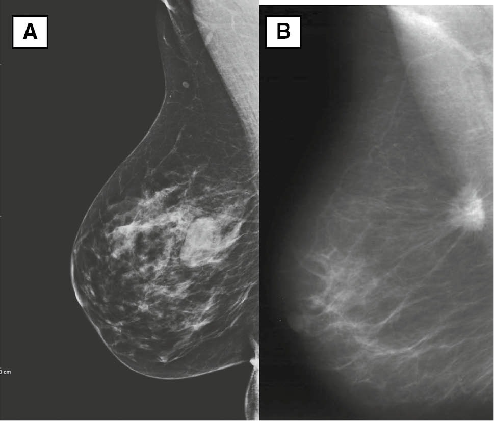 Figure 11: Mediolateral oblique mammogram projection.(A) Heterogeneously dense breast. In the central quadrant of the breast, there is a well-circumscribed 15×20 mm mass, with smooth margins and uniform density. No calcifications or associated findings in the breast. Conclusion: BI-RADS 2, benign mass, possible fibroadenoma. (B) Mediolateral oblique mammogram projection. Fatty tissue breast. Near the chest wall there is a high density, spiculated irregular, 10×15 mm mass, with distortion of the surrounding parenchyma. Conclusion: BI-RADS 5, malignant mass, invasive carcinoma.