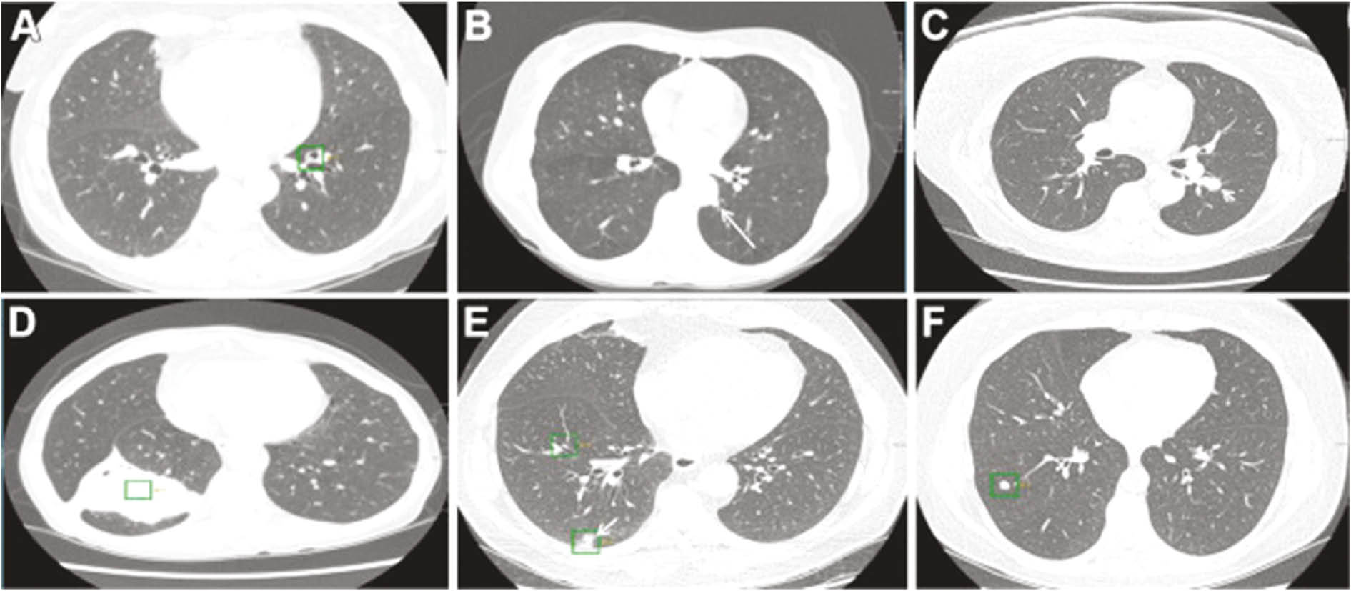 Figure 12: Chest CT.These are examples of how malignant masses were missed by radiologists because of their unusual location – e.g. close to the pleura (D, E) or bronchus and vessels (A, B, C, F) where the radiologist is used to seeing such large structures as organs, thus tending to miss smaller masses.