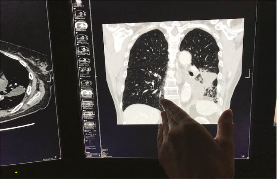 Figure 13: The radiologist shows reduction of the left lung because of the progressing tumor, which also caused the dislocation of the mediastinum and left diaphragm.