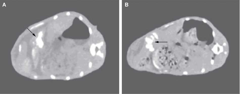 Figure 8 CT image of a rabbit abdomen after the injection of the magnetic fluid (A) day 1 and (B) day 14. Accumlation of magnetic nanoparticles onto the tumors are shown by the arrows. Source: Ref. (36).