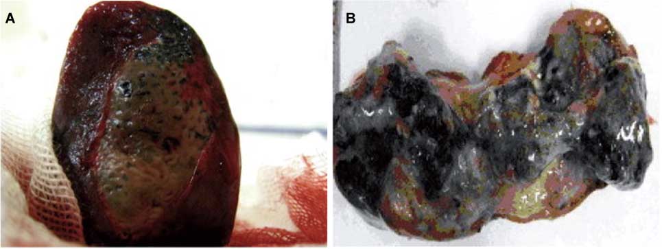 Figure 9 (A) A photograph of the liver tumor immediately before repeated hyperthermia. Local coagulation necrosis with a clear boundary line and magnetic fluid (black) infiltrating into the tumor surface was observed. (B) In the cross-section of the same tumor, almost complete necrosis of the tumor tissue and magnetic fluid that filled the tumor was observed macroscopically. Source: Ref. (36).