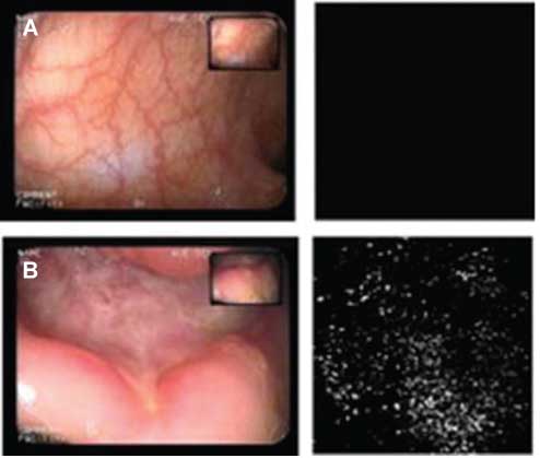 Figure 5 (A) Negligible amounts of PLGA-nanoparticles are detectable on the mucosal surface of a patient with UC in remission and (B) A pronounced accumulation of microparticles is detectable in a rectal ulcer of a CD patient. Reprinted from (131) Schmidt C, et al., Nano- and microscaled particles for drug targeting to the inflamed intestinal mucosa- A first in vivo study in human patients. J Control Release 2013;165:139–45. 2012 Nov 2 with permission from Elsevier.