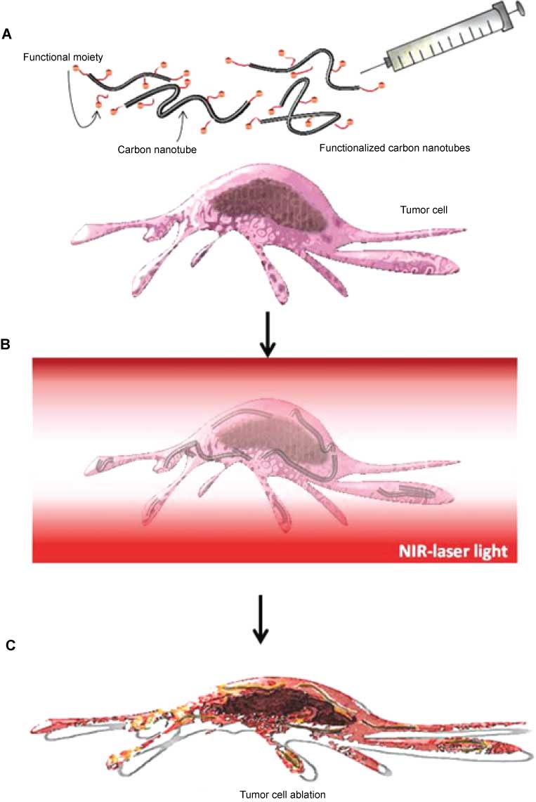 Figure 1 Schematic illustration of anticancer treatment using site-targeted carbon nanotubes for thermal ablation of malignant cells. (A) Intravenous injection of carbon nanotubes into the patient; (B) administration of near-infrared laser light to functionalized carbon nanotubes ingested in targeted cells; (C) irreversible cellular damage of treated tumor cells trigged by locally raised temperature.