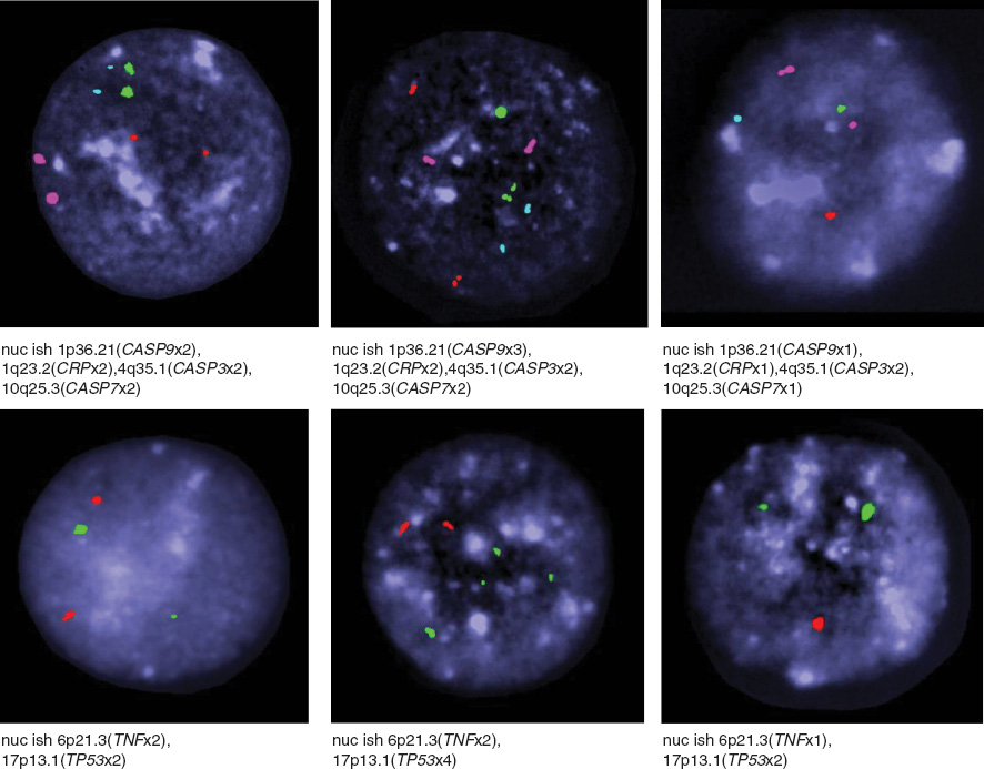 Figure 3 Photographs panel represent examples of variable numbers of signals per nucleus demonstrated with different DNA probes such as CASP3 (pink), CASP7 (red), CASP9 (green), CRP (blue), TP53 (green) and TNF (red), nuclei with DAPI (dark blue) in human blood lymphocytes.