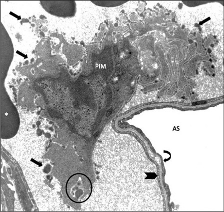 Figure 2: Pulmonary Intravascular Macrophage (PIM) of a sheep, anchored to the pulmonary capillary endothelium.Unique ruffled globular membrane structure (arrows) is present. AS, alveolar space; *, red blood cells; circle, phagocytosis; thick arrow, capillary wall; curved arrow, aveolar epithelium; magnification, X10,000. Modified from Ref. (25).