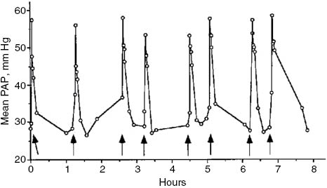Figure 3: PAP responses to repetitive liposome injections. A pig was injected intravenously with 5-mg lipid-containing liposome boluses at indicated time points, and changes in PAP were recorded. Arrows indicate time points of injections. Figure reproduced from (53) with permission.