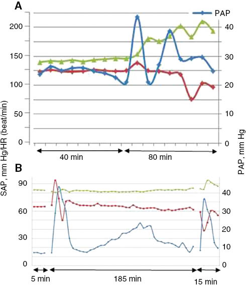 Figure 4: Examples of delayed and or protracted pulmonary hypertension caused by reactogenic nanomedicines. Excerpts from experiments performed in our laboratory, in collaboration with the suppliers of RNMs, which were conjugated (A) and PEGylated (B) small unilamellar liposomes (SUV). Blue, red and green indicate PAP, SAP and heart rate curves registered continuously. Unpublished data.