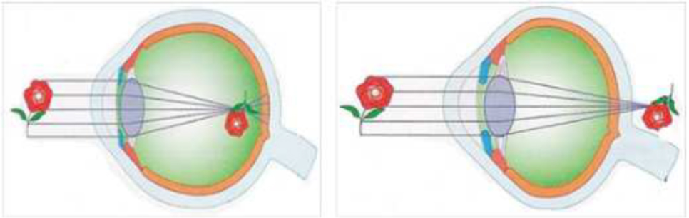 Figure 2 The structure of the eye in cases of myopia and hyperopia