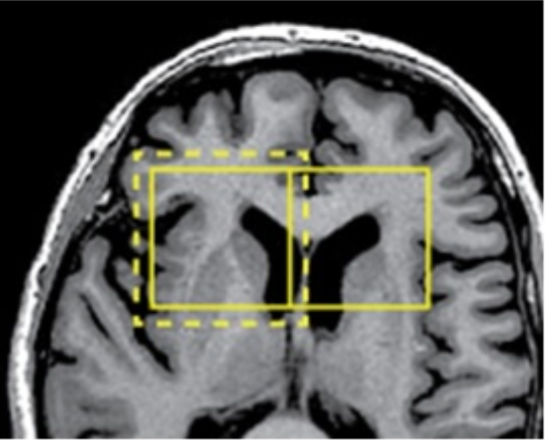 Figure 1 Overlap of regions in the processed image