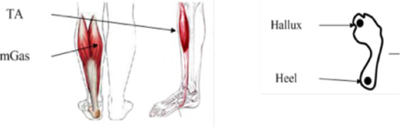 Figure 2 Electrode placement of footswitch and EMG signals