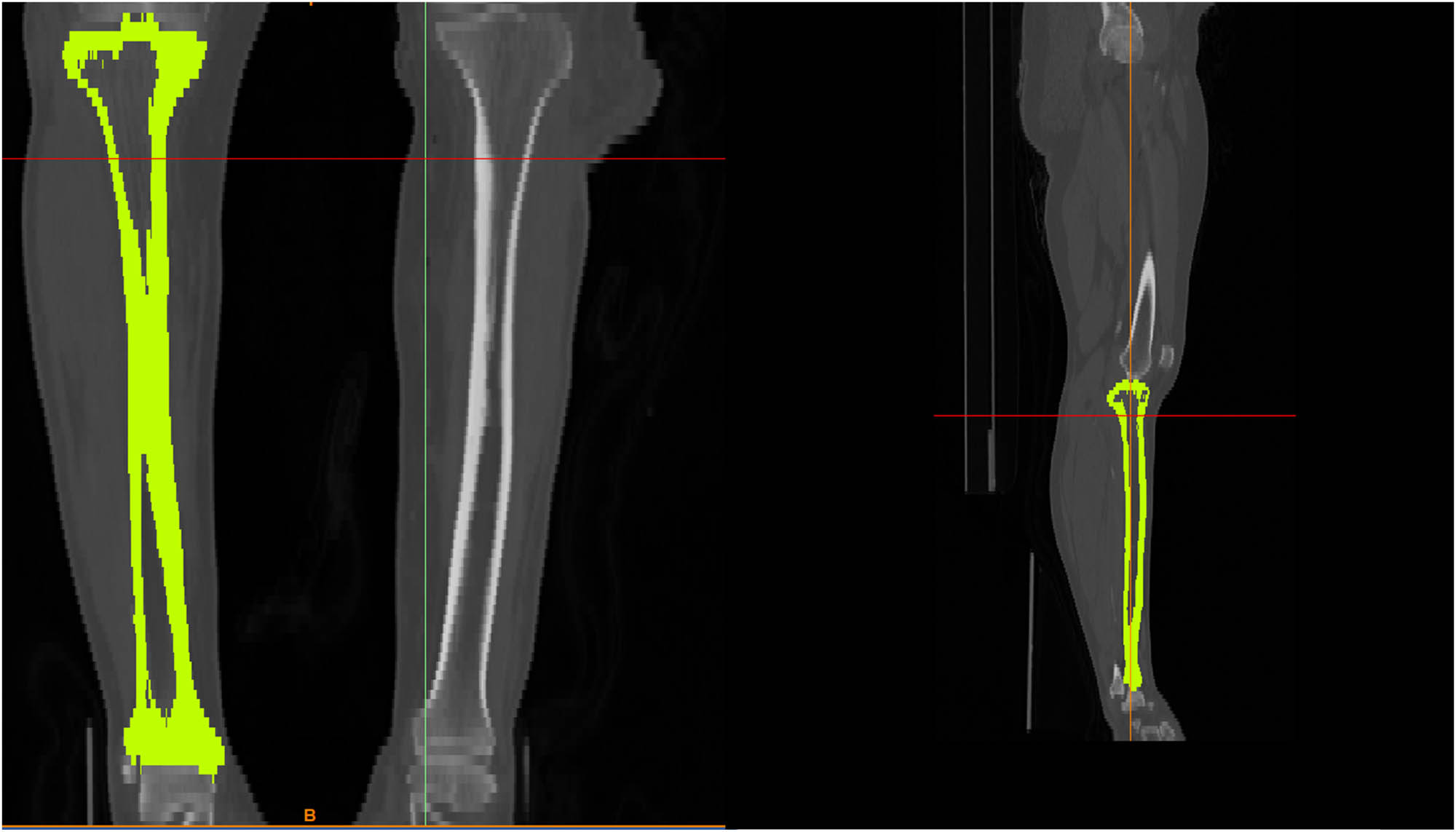 Figure 1 
               Tibia bone undergoes a process of segmentation and treatment in order to facilitate the creation of a 3D module.
            