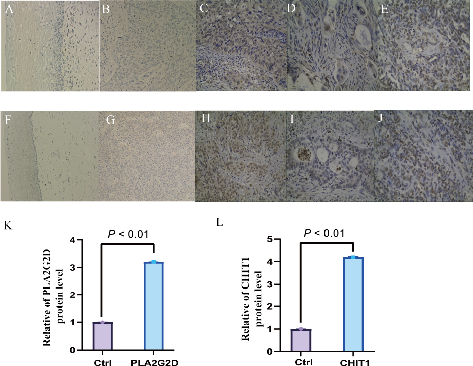 Fig. 9
Expression changes of PLA2G2D and CHIT1 in tumor tissues of cervical squamous cell carcinoma (CESC) patients and normal controls
(A) Negative expression of PLA2G2D in normal cervical epithelium; (B-C) Low and high expression of PLA2G2D in cervical squamous cell carcinoma; (D-E) Low and high expression of PLA2G2D in cervical adenocarcinoma; (F) Negative expression of CHIT1 in normal cervical epithelium; (G-H) Low and high expression of CHIT1 in cervical squamous cell carcinoma; (I-J) Low and high expression of CHIT1 in cervical adenocarcinoma (100x); (K-L) Immunohistochemical results of expression of PLA2G2D and CHIT1 in tumor tissues of CESC patients and normal controls.